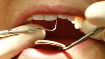 American scientists find technique to prevent dental cavities; flossing, cutting down sugar among ways to protect teeth