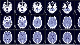 With advances in surgical and radiological techniques, brain and spine tumour operations are now safe