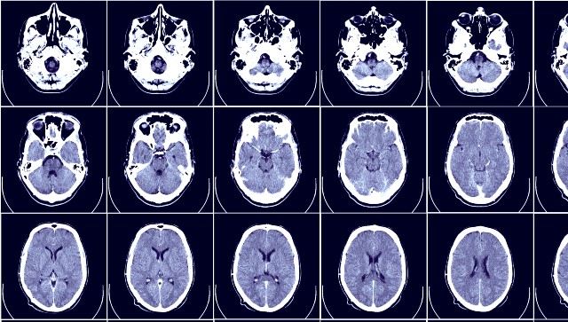 National Epilepsy Day 2021: Symptoms, causes and tips for managing seizures National Epilepsy Day 2021: Symptoms, causes and tips for managing seizures