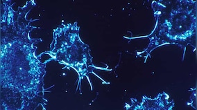 Young onset of esophageal cancer is rare but on the rise: Study says poor five-year survival rate likely among patients