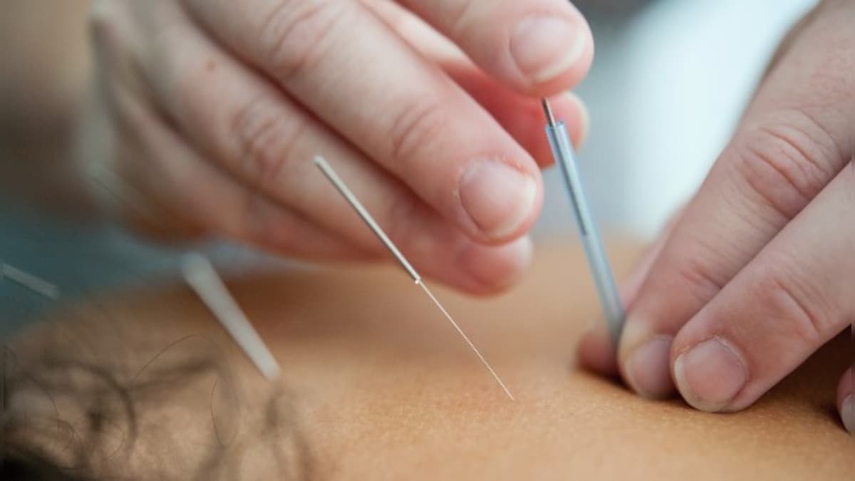 Acupuncture before surgery may help lower pain, anxiety and opioid use afterwards, reveals study