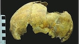 Russian Scientists discover 5,000-year-old skull of failed brain surgery patient in Crimea