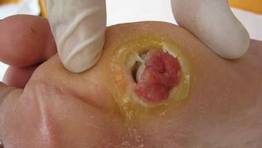 Diabetes can silently affect feet leading to neuropathy, ulcers and even amputation