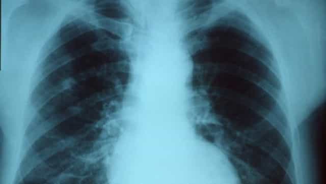 World Pneumonia Day 2020: With COVID-19 raging on, focus on this respiratory disease beyond pandemic is critical World Pneumonia Day 2020: With COVID-19 raging on, focus on this respiratory disease beyond pandemic is critical