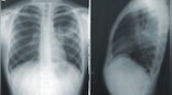 World Pneumonia Day 2021: How to mitigate risk of contracting deadly respiratory infection