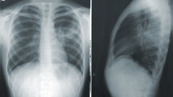 World Pneumonia Day 2021: How to mitigate risk of contracting deadly respiratory infection