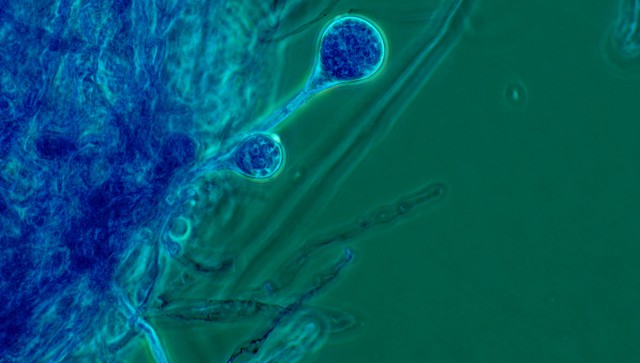 COVID-19-triggered mucormycosis cases rise in India: Symptoms, treatment and risk factors of deadly black fungal infection COVID-19-triggered mucormycosis cases rise in India: Symptoms, treatment and risk factors of deadly black fungal infection