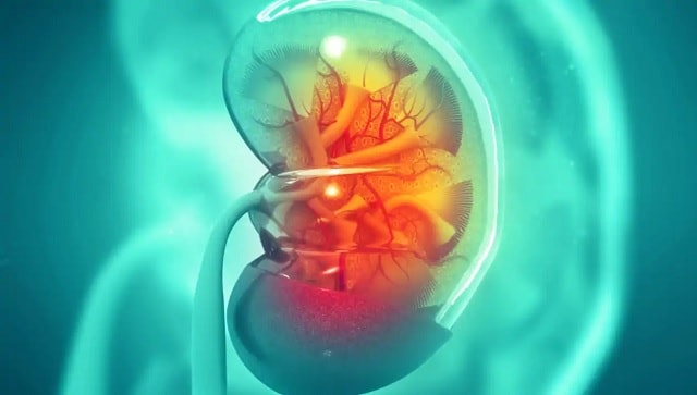 How obesity and hypertension heighten risks of kidney cancer