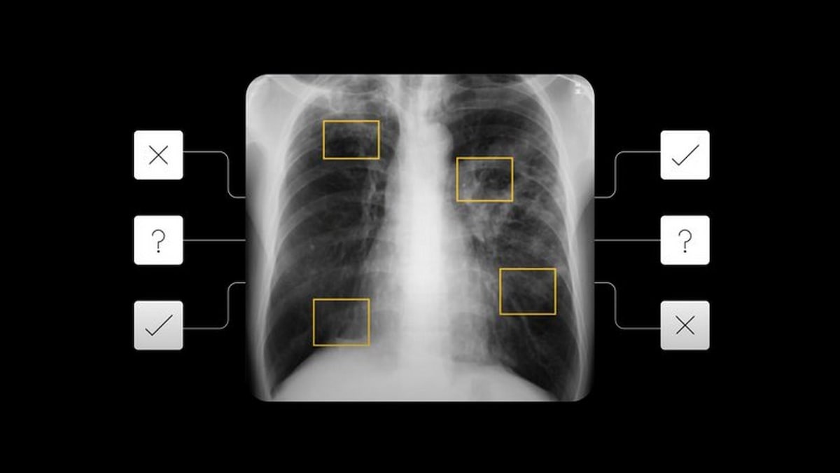 Google I/O 2021: AI tool to detect active pulmonary tuberculosis announced