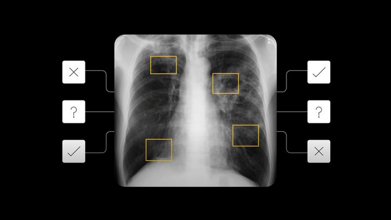 Google I/O 2021: AI tool to detect active pulmonary tuberculosis announced Google I/O 2021: AI tool to detect active pulmonary tuberculosis announced