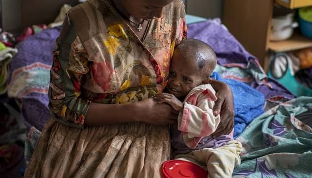  Amanuel Mulu, a 22 month-old baby, is suffering from malnutrition and weighs only 6.7 kilograms. Photo by AP/Ben Curtis
