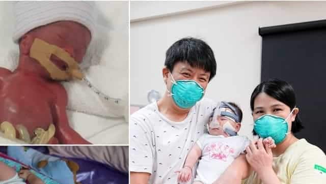World’s Smallest Baby Discharged After Surviving 13 Long Months