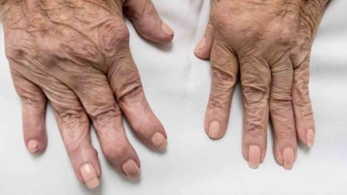 Almost 1.3 crore people in India suffer from rheumatoid arthritis; disease not restricted to the older generation