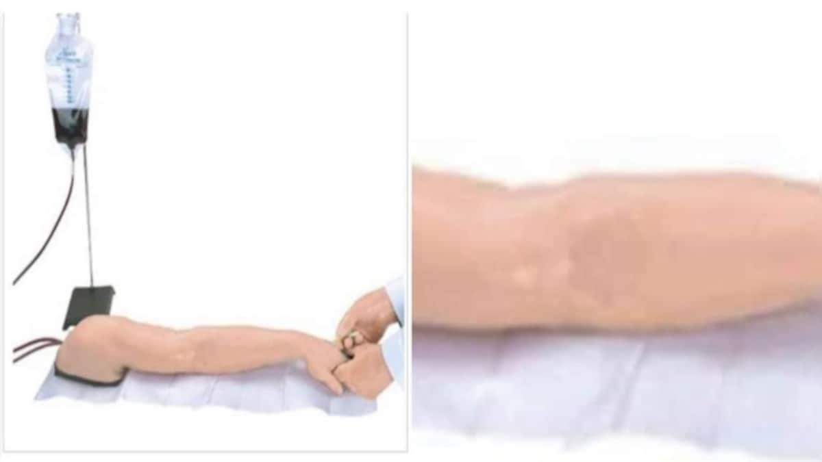 Anti-vaxxer sells $1,500 prosthetic arm to escape getting vaccinated; post goes viral