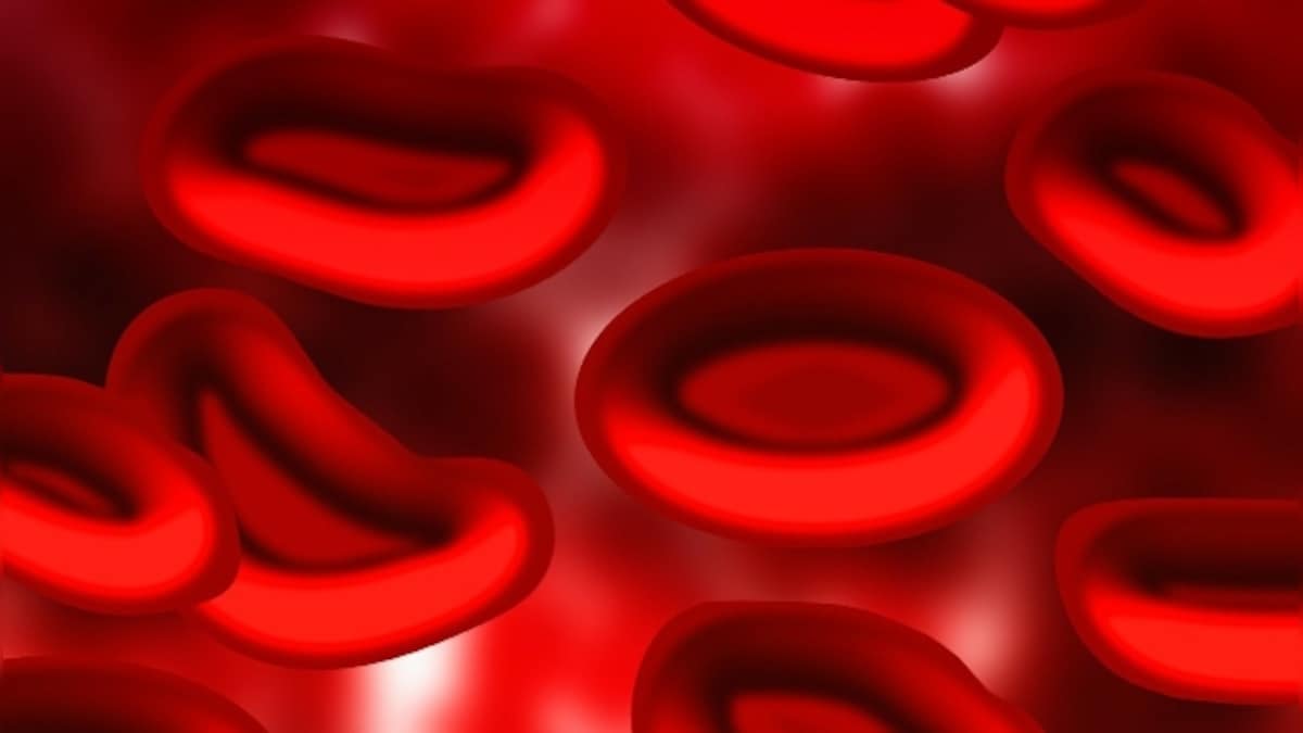 Hydroxyurea gets DCGI nod for treatment of sickle cell anaemia: all you need to know