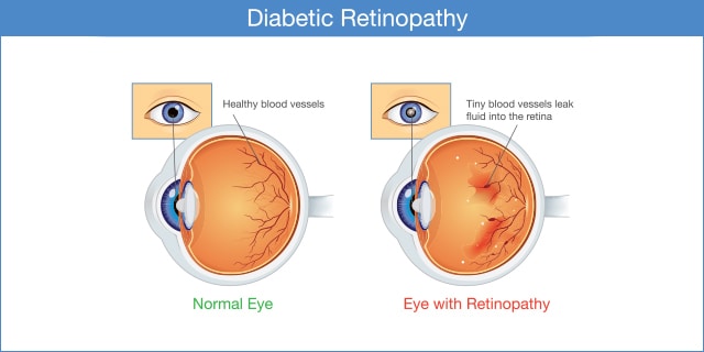 Complications oculaires que vous devez connaître si vous vivez avec le diabète.-Health News , Firstpost