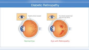 Eye complications that you should know about, if you live with diabetes.