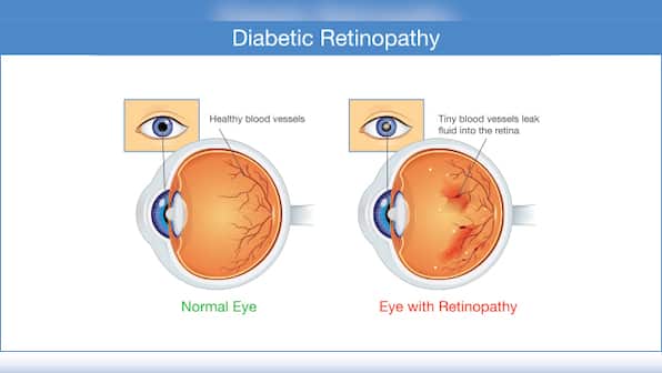 Eye complications that you should know about, if you live with diabetes.