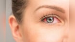 Irritated with itching sensation in your eyes? Check out these home remedies