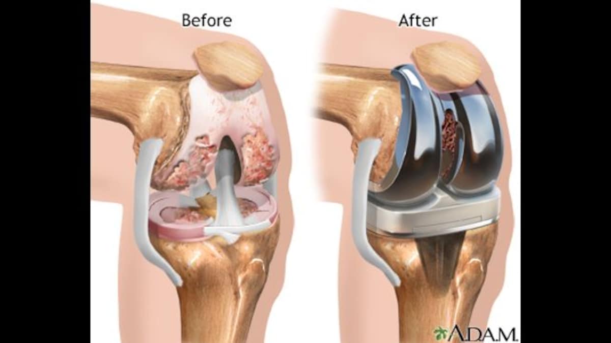 Why younger patients are opting for joint replacement surgery