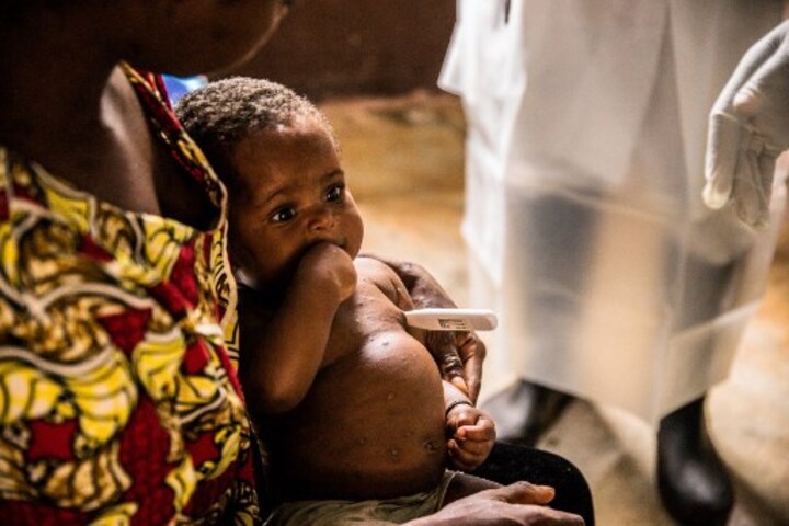 After UK and Europe, rare monkeypox case found in US: What you must know about the virus