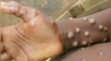 Spain: Gay community warns everyone as monkeypox spreads