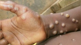 Spain: Gay community warns everyone as monkeypox spreads