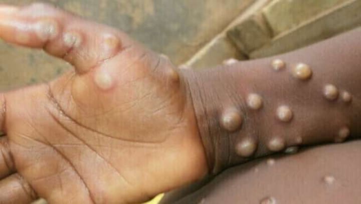 ICMR planning sero-survey among contacts of monkeypox patients