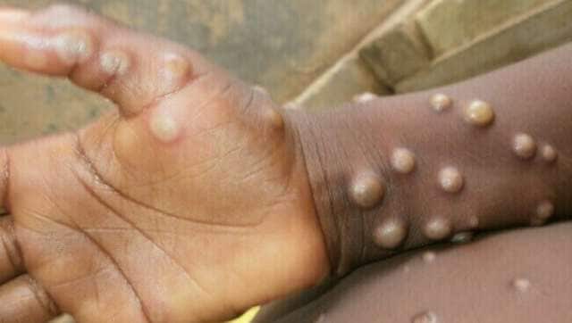 Monkeypox declared global health emergency by WHO after outbreak in over 70 countries