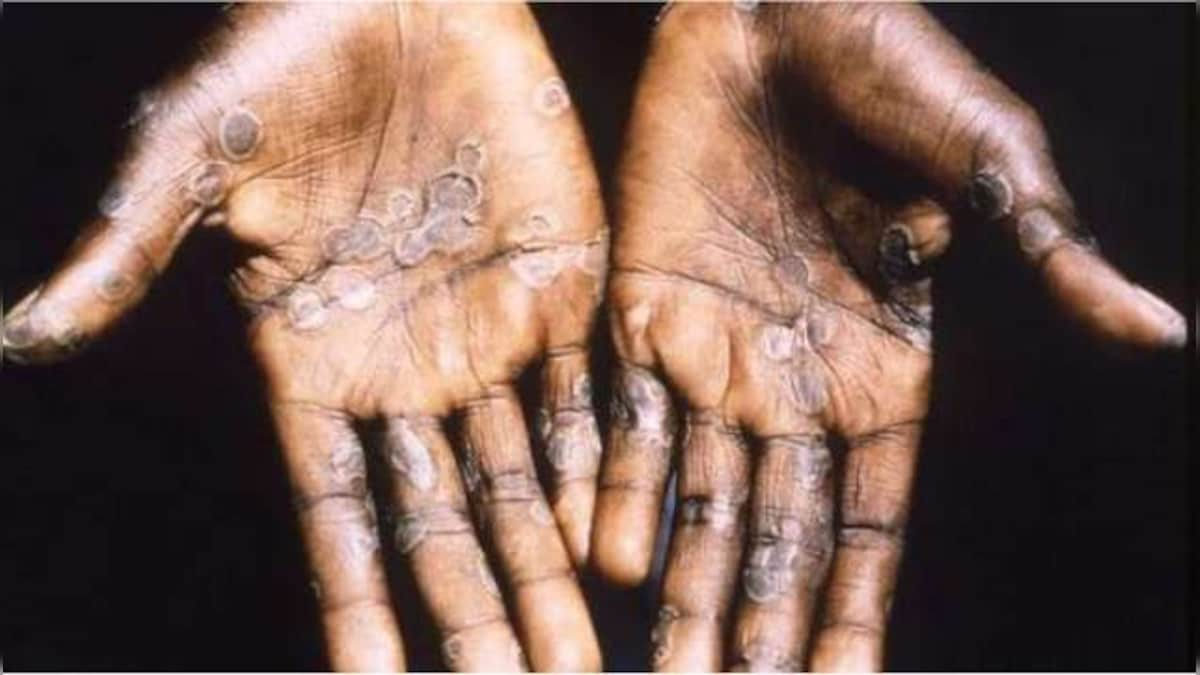 Surveillance, rapid identification, isolation: Centre issues guidelines on monkeypox