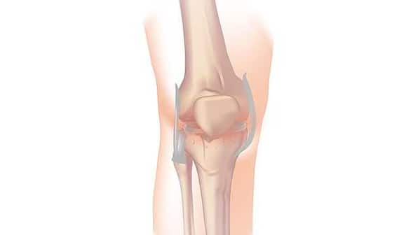 Is there a link between osteoarthritis and obesity? Here's what expert says