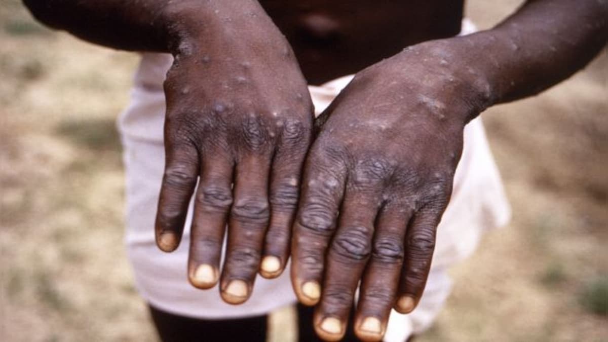 Monkeypox infectivity less, but can be fatal for children, say experts