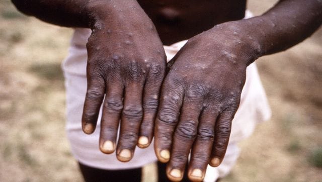First monkeypox case reported in Delhi, man with no foreign travel history tests positive; India's tally rises to four