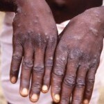 Explained: How fast does monkeypox spread and should India worry?