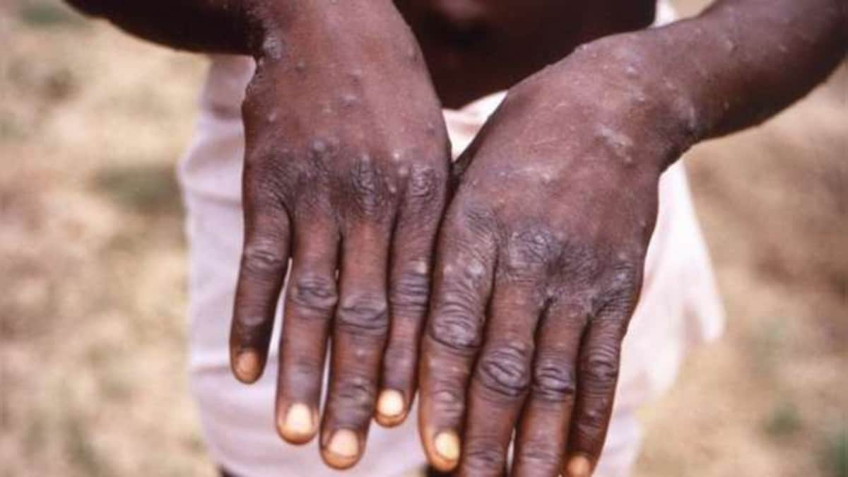 New York asks WHO to re-name monkeypox to avoid stigmatizing patients