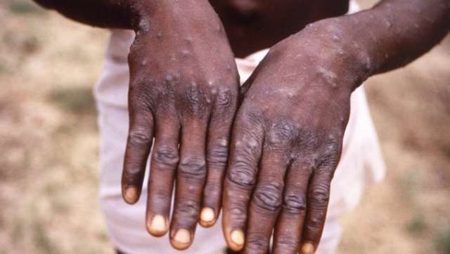 Government ready and alert against monkeypox, says National Centre for Disease Control Government ready and alert against monkeypox, says National Centre for Disease Control