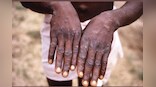 UN denounces ‘homophobic and racist’ reporting on monkeypox; warns of exacerbating stigma