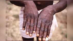 UN denounces ‘homophobic and racist’ reporting on monkeypox; warns of exacerbating stigma