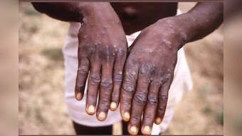 UN denounces ‘homophobic and racist’ reporting on monkeypox; warns of exacerbating stigma