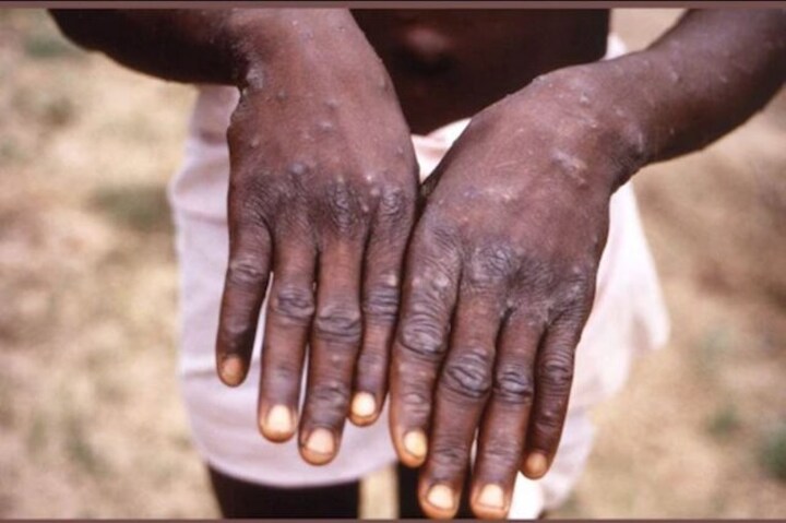 UN denounces ‘homophobic and racist’ reporting on monkeypox; warns of exacerbating stigma