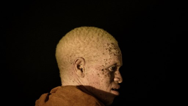 International Albinism Awareness Day 2022: All you need to know about day's history, significance and theme International Albinism Awareness Day 2022: All you need to know about day's history, significance and theme