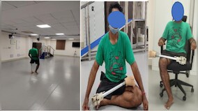 Explained: How India’s new prosthetic limb will make life easier for the specially abled