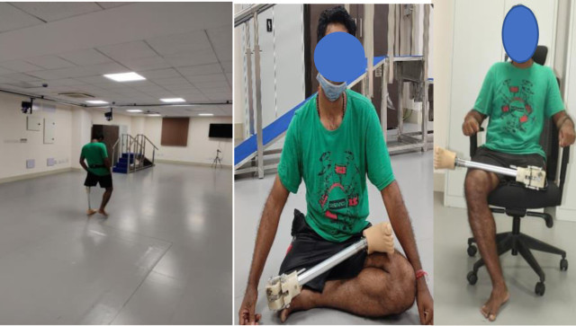 Explained: How India’s new prosthetic limb will make life easier for the specially abled Explained: How India’s new prosthetic limb will make life easier for the specially abled