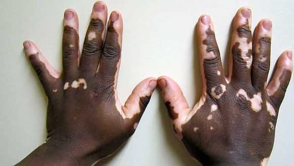 World Vitiligo Day: All you need to know about the autoimmune disorder
