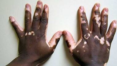 World Vitiligo Day: All you need to know about the autoimmune disorder
