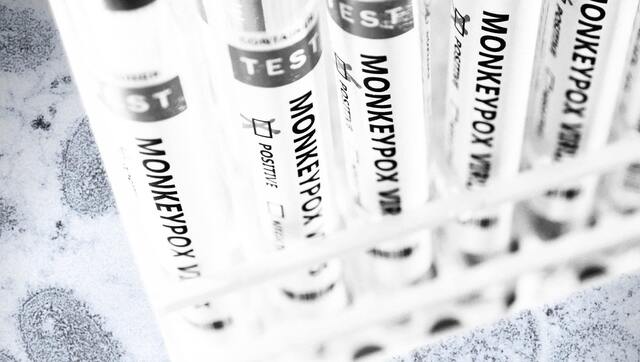 Nepal: Man hospitalised with suspected monkeypox symptoms Nepal: Man hospitalised with suspected monkeypox symptoms