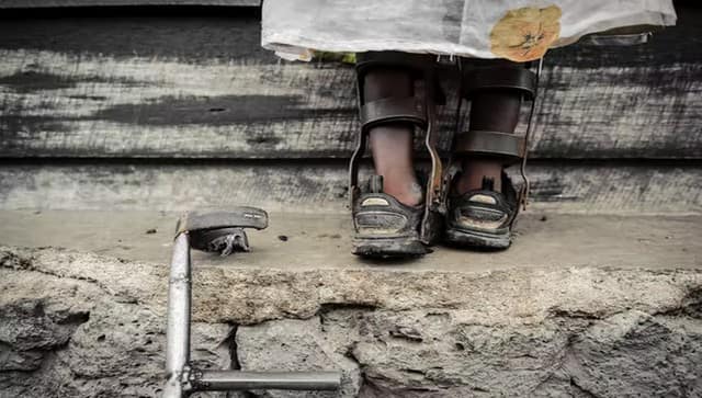 The crippling effects of polio. The Conversation