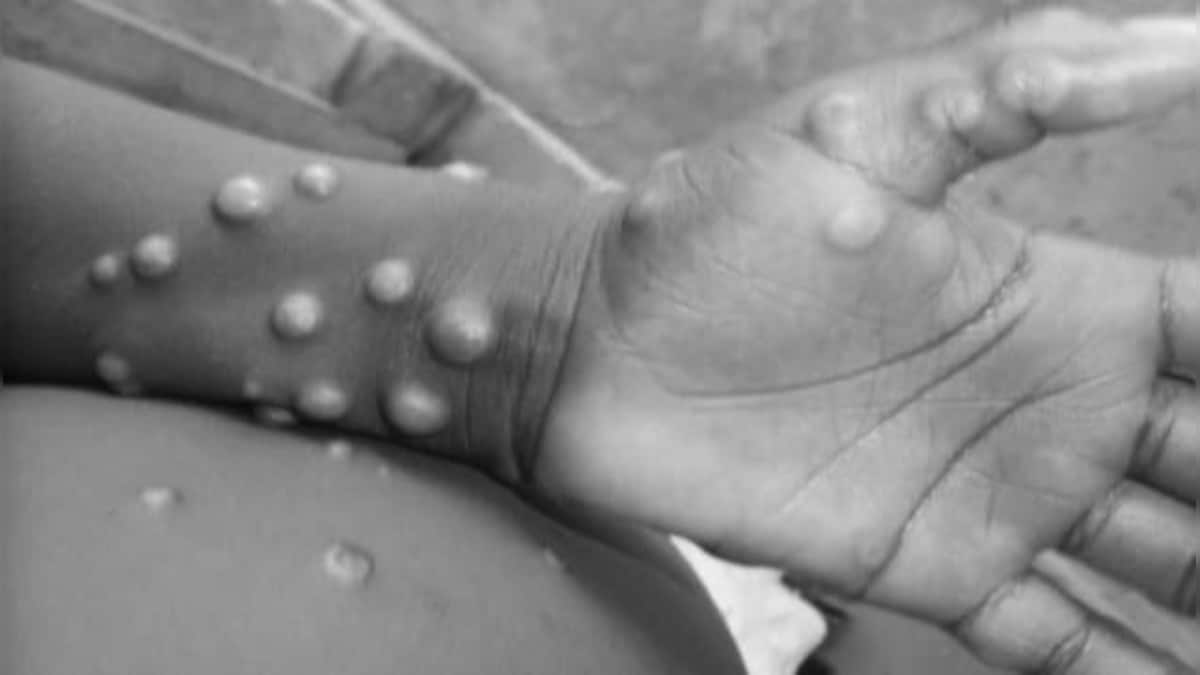 Health officials concede monkeypox elimination unlikely in US