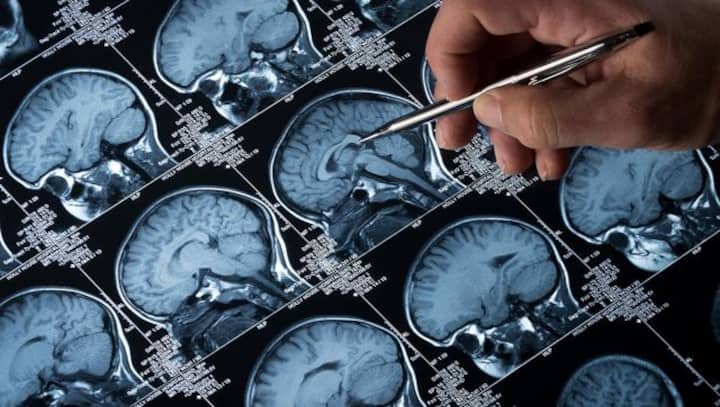 Delhi hospital launches 'brain mapping device', claims it is first-of-its-kind technology Delhi hospital launches 'brain mapping device', claims it is first-of-its-kind technology
