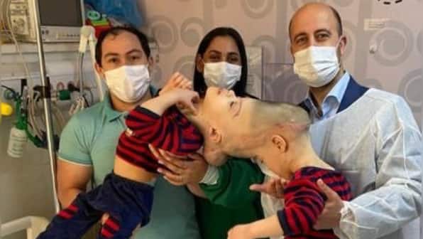 How Kashmir-origin doctor separated Brazilian twins fused at the brain